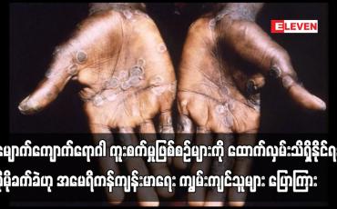 Embedded thumbnail for မျောက်ကျောက်ရောဂါ ကူးစက်မှုဖြစ်စဉ်များကို ထောက်လှမ်းသိရှိရန် ပိုမိုခက်ခဲ