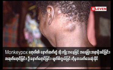 Embedded thumbnail for Monkeypox ရောဂါ၏ နောက်ဆက်တွဲ ဆိုးကျိုးအနေဖြင့် အရေပြားအနာပိုးဝင်ခြင်း၊
