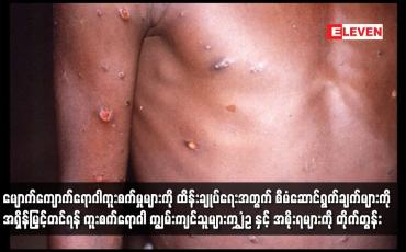 Embedded thumbnail for မျောက်ကျောက်ရောဂါကူးစက်မှုများကို ထိန်းချုပ်ရေးအတွက် စီမံဆောင်ရွက်ချက်များကို