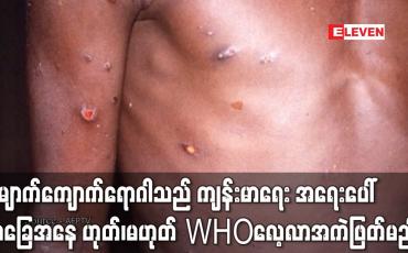 Embedded thumbnail for မျောက်ကျောက်ရောဂါသည် နိုင်ငံတကာ ကျန်းမာရေး အရေးပေါ်အခြေအနေ ဟုတ်၊မဟုတ်