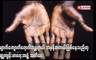 Embedded thumbnail for ၂၉ နိုင်ငံ၌ ကူးစက်ခံရသူ ၁,၀၀၀ ကျော်ရှိလာချိန်တွင် မျောက်ကျောက်ကူးစက်ရောဂါ
