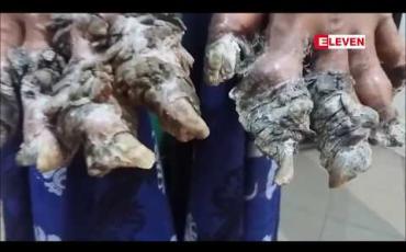 Embedded thumbnail for ဘင်္ဂလားဒေ့ရှ်သစ်ပင်လူသား အခြေအနေဆိုးရွားလာ၍ ဆေးရုံပြန်တက်ခဲ့ရ 