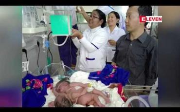 Embedded thumbnail for ကလေးမြို့တွင် မွေးဖွားခဲ့သော ရင်ချင်းဆက်အမွှာ မိန်းကလေးနှစ်ဦး မွေးဖွားပြီး နာရီ ၄၀ ခန့်အကြာတွင် သေဆုံး 