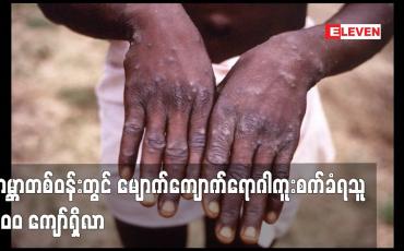 Embedded thumbnail for ကမ္ဘာတစ်ဝန်းတွင် မျောက်ကျောက်ရောဂါကူးစက်ခံရသူ ၂၀၀ ကျော်ရှိလာ