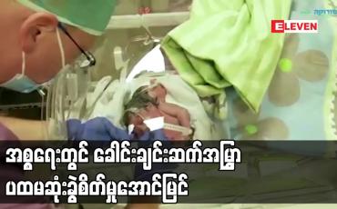 Embedded thumbnail for အစ္စရေးတွင် ခေါင်းချင်းဆက်အမြွှာ ပထမဆုံး ခွဲစိတ်မှု အောင်မြင်