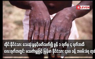 Embedded thumbnail for အမေရိကန်ကျန်းမာရေးအာဏာပိုင်များက ဆရာဝန်များအား မျောက်ကျောက်ရောဂါ ကူးစက်ခံရခြင်း ရှိ၊မရှိ