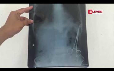 Embedded thumbnail for ခွဲစိတ်ခန်းသုံးကိရိယာ ဝမ်းဗိုက်ထဲကျန်ခဲ့မှုနှင့် ပတ်သက်ပြီး ပေါ့ဆစွာ ခွဲစိတ်ကုသခဲ့သည့် ဆရာဝန်အား အရေးယူပေးရန်တိုင်ကြားထားမှု စစ်ဆေးချက် အဖြေမသိရ၍ လူနာဖြစ်သူက သမ္မတထံ တင်ပြ 