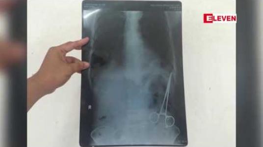Embedded thumbnail for ခွဲစိတ်ခန်းသုံးကိရိယာ ဝမ်းဗိုက်ထဲကျန်ခဲ့သဖြင့် ပေါ့ဆစွာခွဲစိတ်ခဲ့သည့်ဆရာဝန်ကိုအရေးယူပေးရန် တိုင်ကြားမှု လေးလကျော် ကြာသည်အထိ ဖြေရှင်းဆောင်ရွက်ပေးမှုမရှိသေးဟု မိသားစုဝင်များပြော 