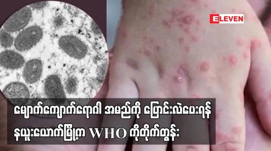 Embedded thumbnail for မျောက်ကျောက်ရောဂါအမည်ကို ပြောင်းလဲပေးရန် နယူးယောက်မြို့က WHO ကိုတိုက်တွန်း