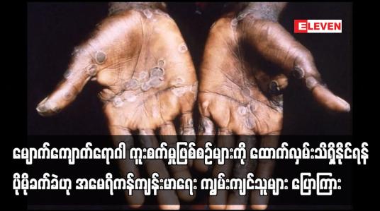 Embedded thumbnail for မျောက်ကျောက်ရောဂါ ကူးစက်မှုဖြစ်စဉ်များကို ထောက်လှမ်းသိရှိရန် ပိုမိုခက်ခဲ