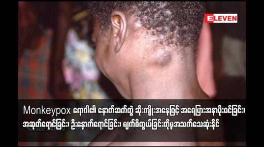 Embedded thumbnail for Monkeypox ရောဂါ၏ နောက်ဆက်တွဲ ဆိုးကျိုးအနေဖြင့် အရေပြားအနာပိုးဝင်ခြင်း၊