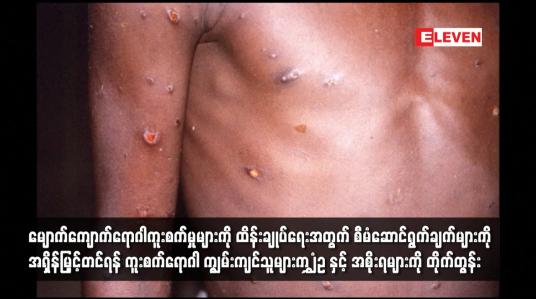 Embedded thumbnail for မျောက်ကျောက်ရောဂါကူးစက်မှုများကို ထိန်းချုပ်ရေးအတွက် စီမံဆောင်ရွက်ချက်များကို