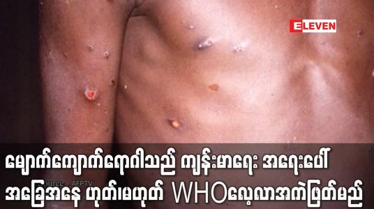 Embedded thumbnail for မျောက်ကျောက်ရောဂါသည် နိုင်ငံတကာ ကျန်းမာရေး အရေးပေါ်အခြေအနေ ဟုတ်၊မဟုတ်