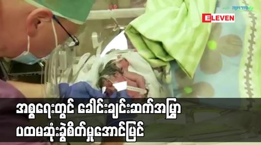 Embedded thumbnail for အစ္စရေးတွင် ခေါင်းချင်းဆက်အမြွှာ ပထမဆုံး ခွဲစိတ်မှု အောင်မြင်